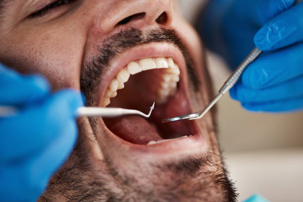 Best Emergency Wisdom Teeth Removal in Brookdale, NJ